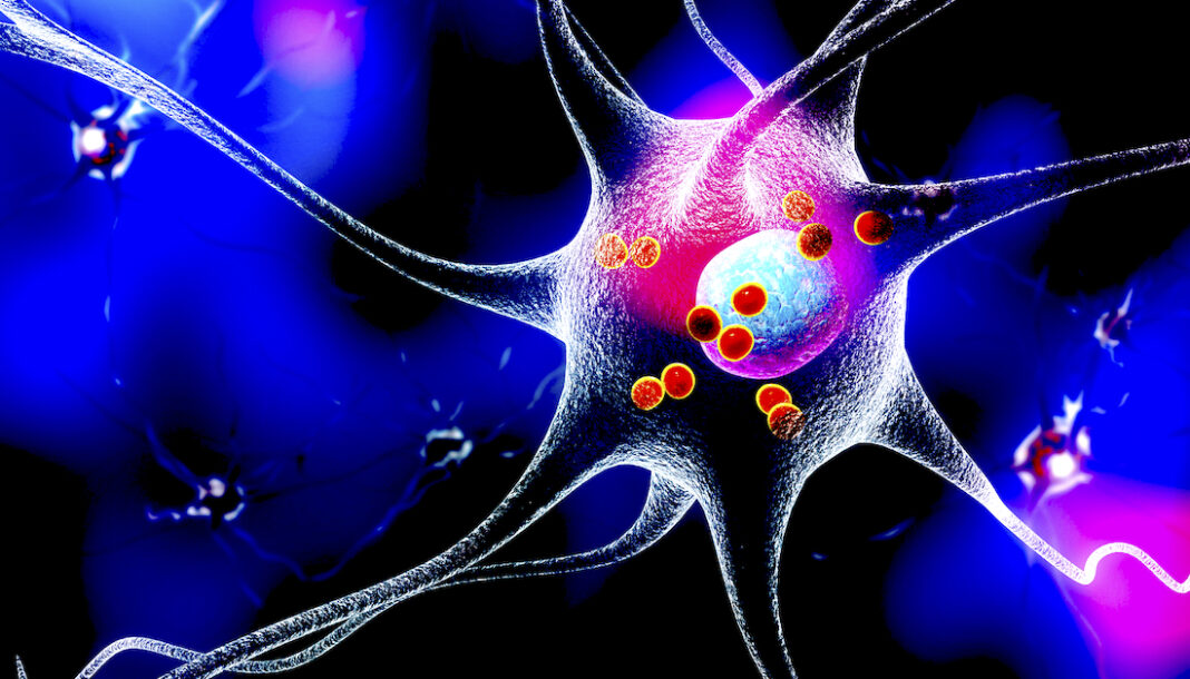 Neurons in Parkinson's disease - stock photo