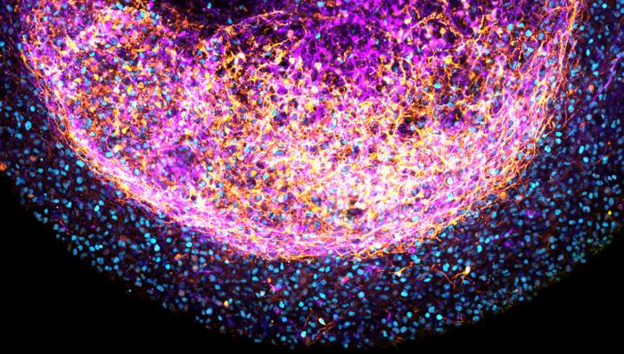 Brain Organoids from Fetal Tissue Take CRISPR Changes, Enable Tumor Modeling