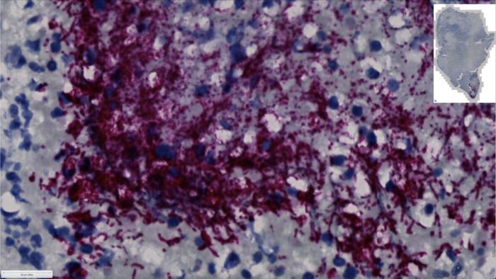 A microscope image shows a human colorectal cancer tumor with Fusobacterium nucleatum stained in a red-purple color. The bacterium is commonly found in people’s mouths. Fred Hutch researchers have found a specific subtype of F. nucleatum that can move to the gut, where it helps colorectal cancer grow.