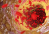 Atherosclerosis Has Tumor-Like Features, May Be Countered by Anticancer Drugs