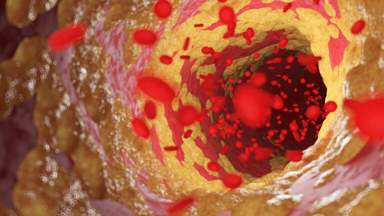 Atherosclerosis Has Tumor-Like Features, May Be Countered by Anticancer Drugs