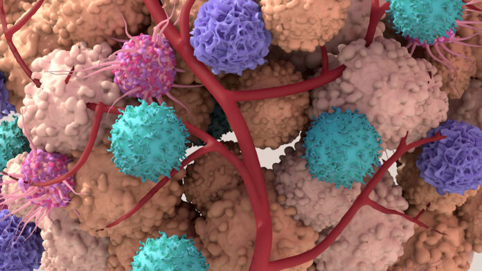 Tumor microenvironment, normal cells, molecules, and blood vessels that surround and feed a tumor cell. Microenvironment can affect how a tumor grows and spreads.