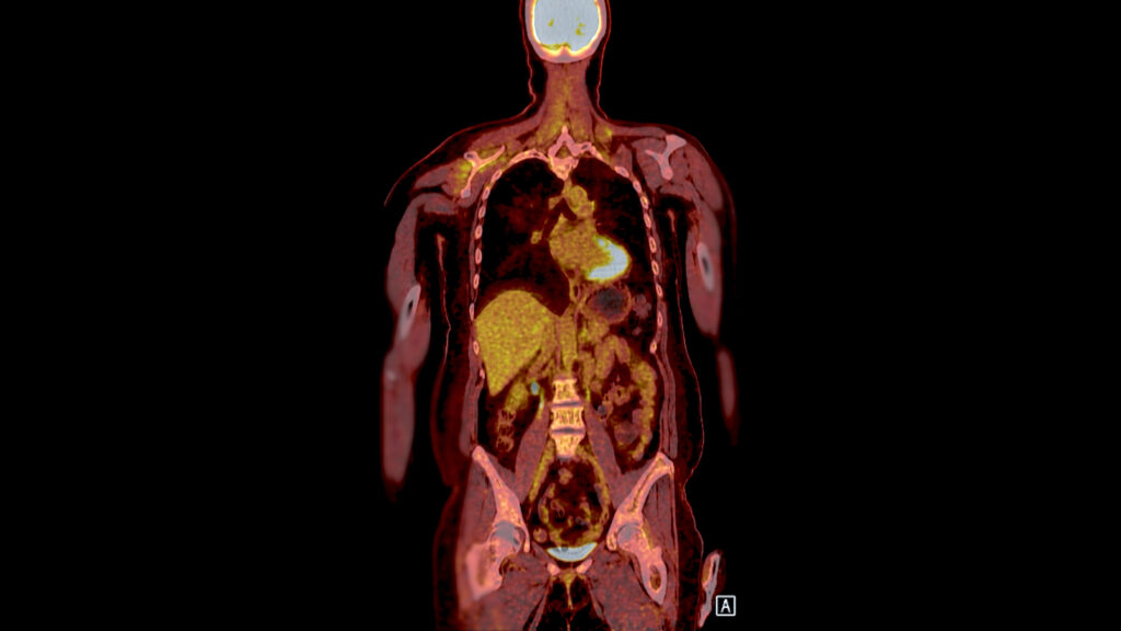 PET CT Scan fusion image It provides detailed images by merging
