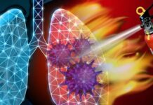 Severe COVID-19 Lung Disease Linked to Ferroptosis