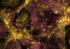 Stem Cell Model Illuminates Genetic Drivers of Neuroblastoma