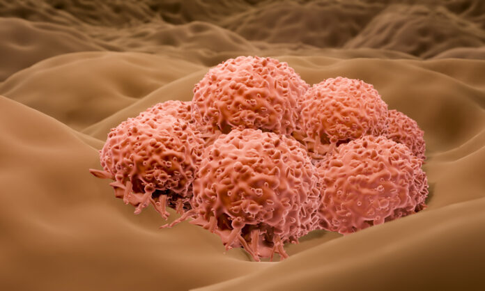 Getty-149838548 melanoma cells