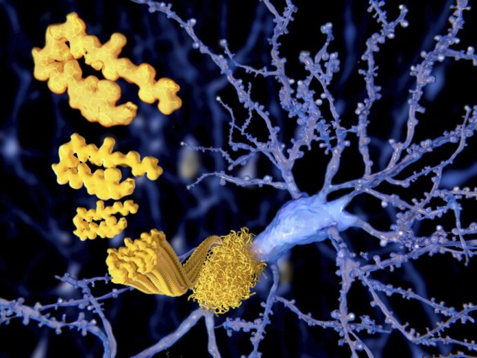 GettyImages-639549099-1068x801 Alzheimer's disease image,with tau proteins highlighted in yellow