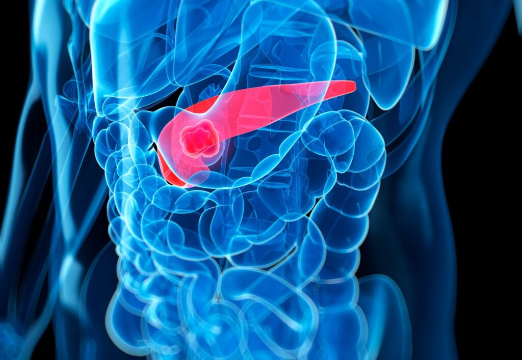 Pancreatic Cancer