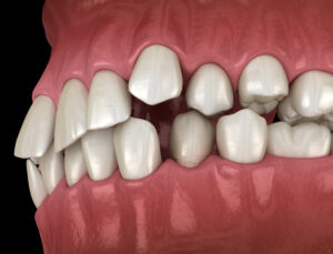 Abnormal teeth position