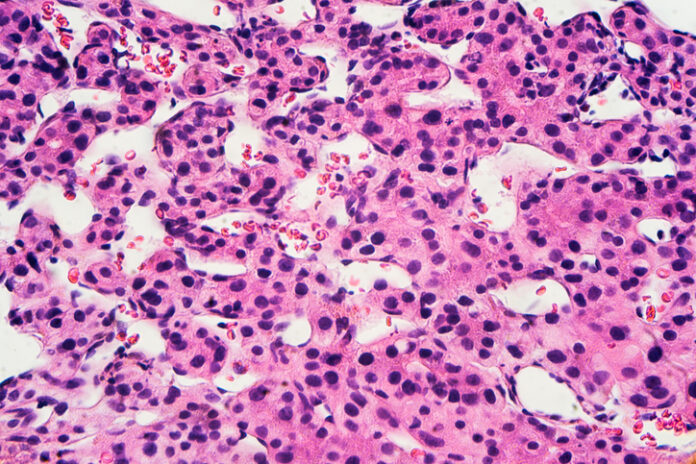 Liver Cancer: Hepatocellular Carcinoma liver cancer cells HCC