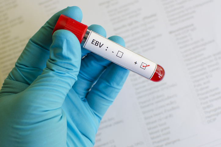 Twenty-Two Genes Could Hike Risk for Long-Term Health Issues After Epstein-Barr Infection
