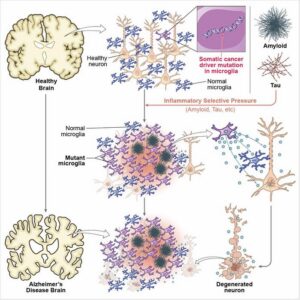 Microglia-like immune cells with cancer mutations (purple) emerge in the brain. Separately, clumps of proteins, like Tau or amyloid, accumulate in the brain, making the environment hostile. Those microglia cells with mutations get selected for survival and proliferation, creating an inflammatory environment that makes innocent bystander neurons die, contributing to Alzheimer’s disease. [Christopher Walsh and colleagues at Boston Children's Hospital]