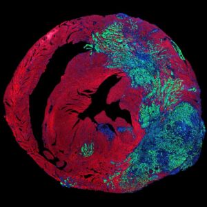 Image of lung cancer cells (in green) growing in a heart, in which cardiomyocytes are stained in red. Nuclei are stained in blue. [Ciucci et al., Science 2026]