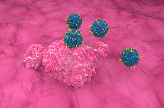 Chimeric antigen receptor (CAR) T cells (blue) attacking bladder cancer.