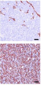 Target for Aggressive Prostate Cancer Prevention Identified in Mice