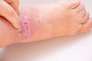 foot wound