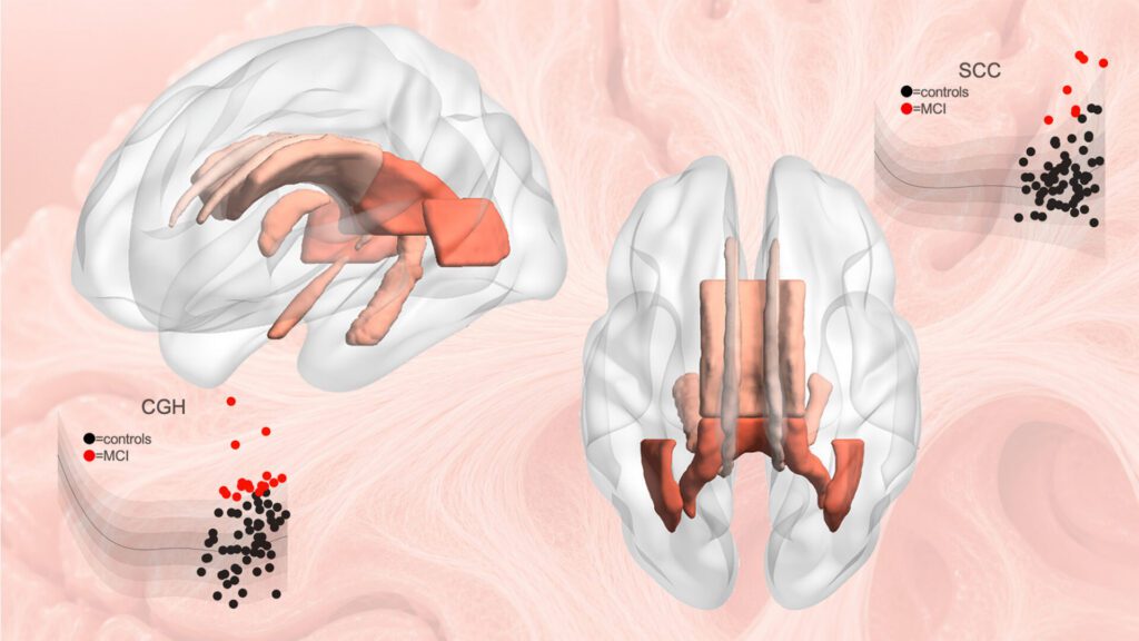 Statistical charts compiled from a large population allow brain abnormalities to be detected in new individuals. [Stevens INI]