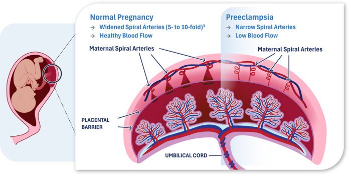 preeclampsia