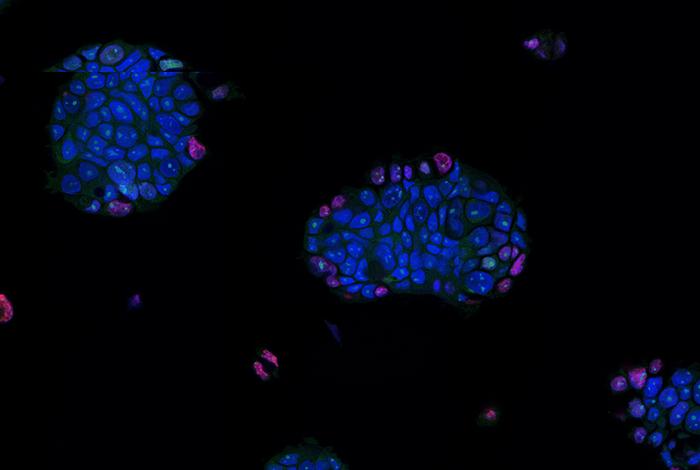 Patient-Derived Tumor Organoids Show Promise for Personalizing Cancer Treatment