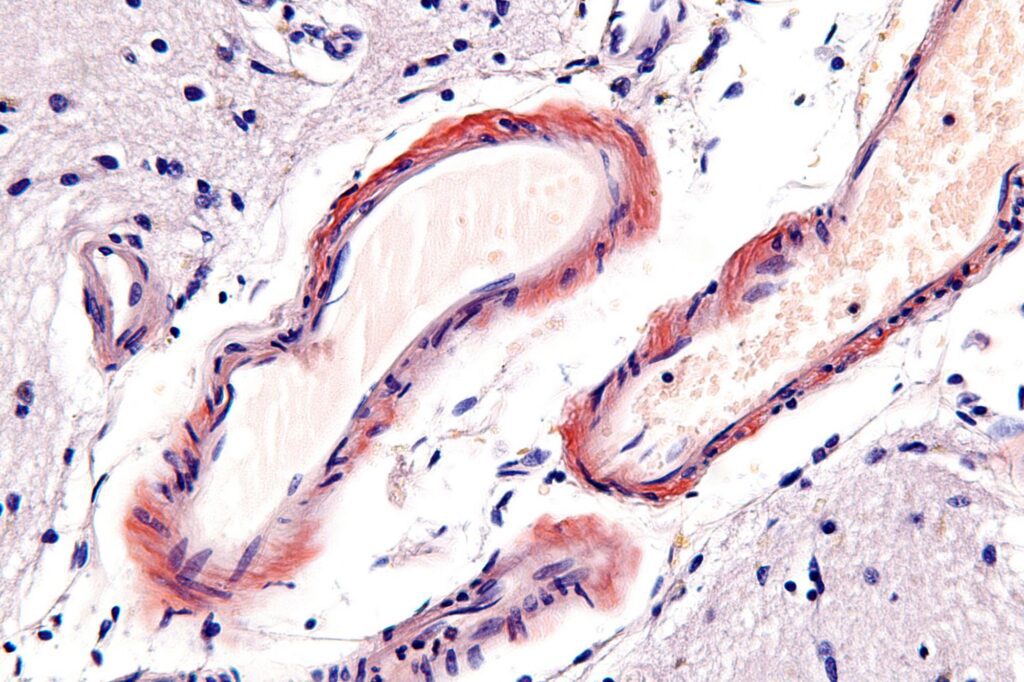 Micrograph of cerebral amyloid angiopathy.