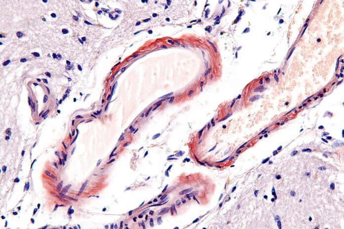 Nephron/commons.wikimedia.org Micrograph of cerebral amyloid angiopathy.