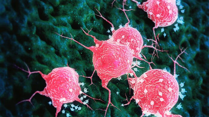 Getty_1405940919_Cancer-696x392