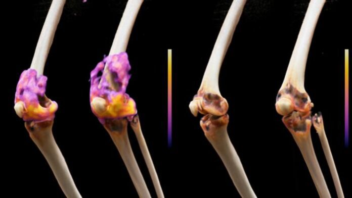rheumatoid arthritis