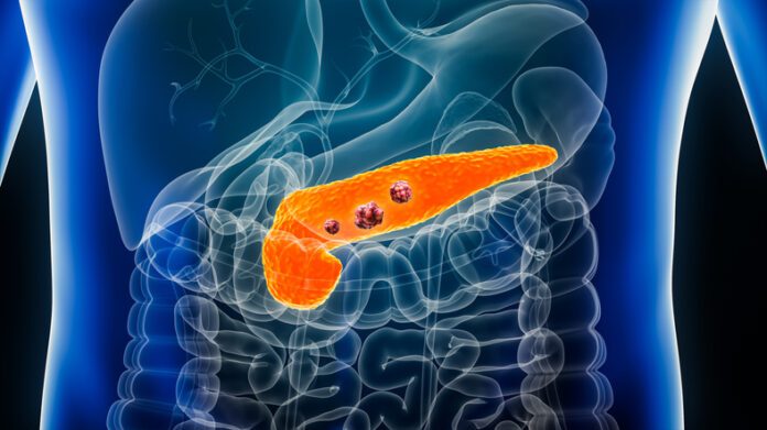 Pancreatic Cancer GettyImages-1467893187-696x391