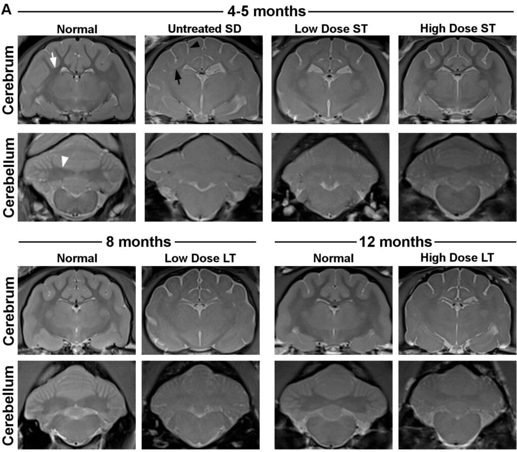 Sandhoff disease gene therapy