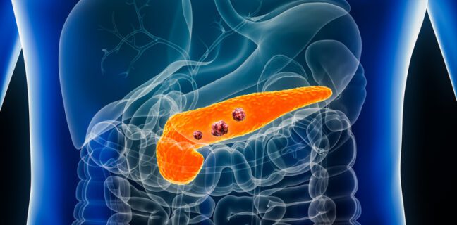 pancreatic cancer illustration