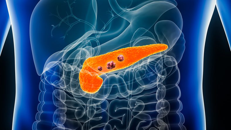 Genialis and Inventia team up to blend AI patient insights with 3D bioprinting for pancreatic cancer drug testing