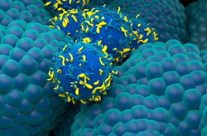 Chimeric antigen receptor (CAR) T cells (blue and yellow) being used to treat prostate cancer (light blue, nodular), illustration.
