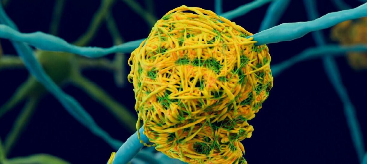 alzheimer's disease