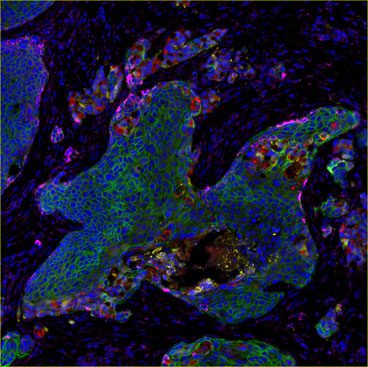 Human squamous cell carcinoma FFPE tissue