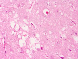 Prion disease, spongiform encephalopathy