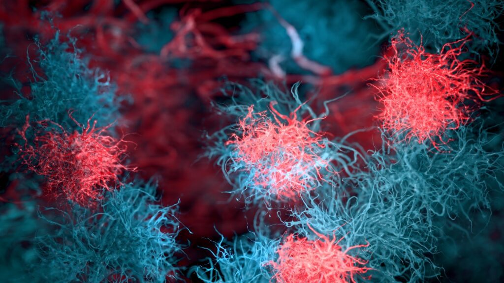 Abstract 3D illustration of a cancer spheroid with malignant cells and dendritic processes, scientific visualization of tumor growth - 3d rendered image, showing a multicellular cancer spheroid. The image features a central malignant core with glowing metabolic activity and long, irregular fibrous protrusions (filopodia) extending into the dark void. This visualization represents tumor invasion, oncology research, and complex cellular structures used in drug testing and cancer therapy studies. Perfect for medical, scientific, and educational editorial or commercial projects.
