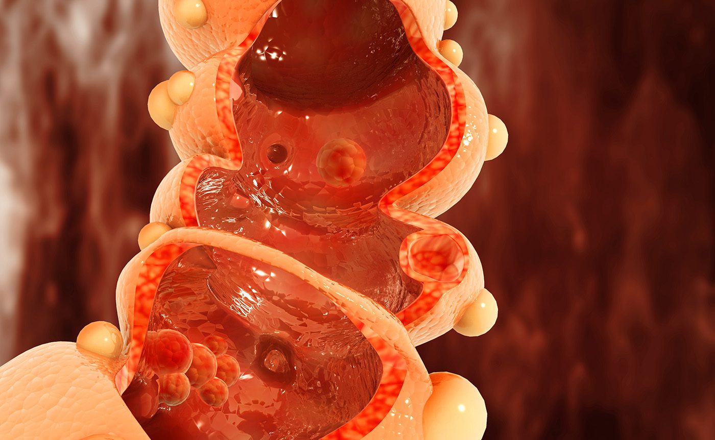 Single-Cell Multiomics: Phenotypic Plasticity in Colorectal Cancer Metastasis