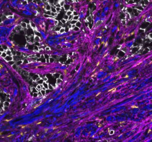 Human prostate cancer