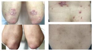 Psoriasis patients prescribed pantethine capsules in addition to topical ointments show a marked improvement in symptoms after 3 months of treatment (bottom). [© 2026 Cao et al. Originally published in Journal of Experimental Medicine. https://doi.org/10.1084/jem.20252558]