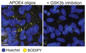 An enlarged figure from the paper shows that untreated APOE4 oligodendrocytes (left) accumulate lipid droplets (yellow), but are rescued by Gsk3b inhibition (right). [Tsai Lab/MIT PIcower Institute] 
