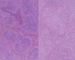 Spleen tissue from a mouse without PHF19 (left) and a mouse with normal PHF19 function (right). Dense clusters of immune cells sit within blood-rich regions in pink. Without PHF19, cells are altered in their differentiation process 