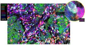 >19,000 genes and the 64-plex CosMx Human Immuno-Oncology Protein panel